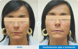Antes e depois logo após o tratamento facial com Ultraformer III