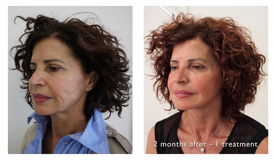 Ultraformer III, revolução tecnológica em tratamentos faciais