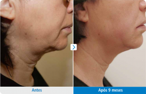 Flacidez pescoço tratado com Ultraformer III